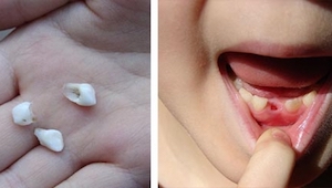 V žádném případě nevyhazujte mléčné zuby Vašich dětí! Později se Vám za to poděk