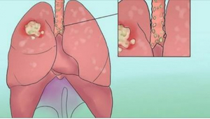 Pokud se diagnostikuje včas, lze rakovinu plic vyléčit. Tyto příznaky rozhodně n