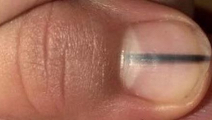 Šokující: Manikérka si všimnula černé čáry na nehtu klientky. Radila ji okamžitě