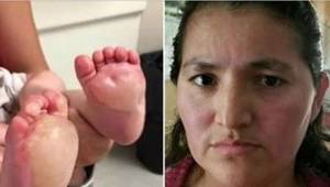 Žena uviděla na nohách svého dítěte obrovské puchýře. Lékaři jí řekli šokující p