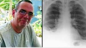 Lékaři operovali pacienta s rakovinou plic. V jeho plicích našli něco, co u nich
